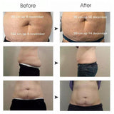 Cryolipolysis Body Contouring Cellulite Removal Fat Freezing For Fat Reduction