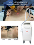 Picosecond Laser With 6Pcs Replacement Heads Freckle All Color Pigment Removal Beauty Equqipment Accept Oem/Odm Order