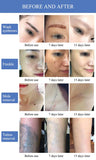 Picosecond Laser With 6Pcs Replacement Heads Freckle All Color Pigment Removal Beauty Equqipment Accept Oem/Odm Order