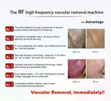 2021 Come The RF High Frequency Vascular Removal Blood Vessel Spider Vein Removals