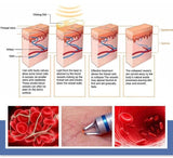 980nm Diode Laser Spider Vein Removal 980 Diode Vascular Laser Removal Machine