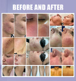 M22 IPL Multifunctional Laser Skin Rejuvenation Chooses for Acne and Wrinkle Removal Treatment