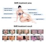 Ipl Laser Hair Removal Elight Skin Rejuvenation Face Lifting OPT Shr Two Years Warranty