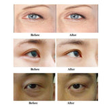 RF for Eyes Bags Dark Circles Removal Golden Eye Face Lifting Wrinkle Remove Care Machine