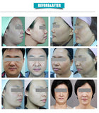 Standard 5 Cartridges Vmax HIFU Face High Intensity Focused Ultrasound Face Lifting Wrinkle Removal System